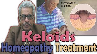 Keloids  Causes Symptoms and Treatment in Homeopathy by Dr PS Tiwari [upl. by Arni]