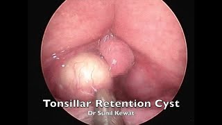 Tonsillar Retention Cyst  Incision and Drainage  Dr Sunil Kewat [upl. by Llerut]