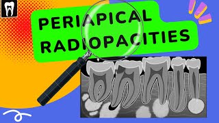 Periapical lesions  Periapical radiopacities  Oral radiology Apical radiopacities [upl. by Migeon]