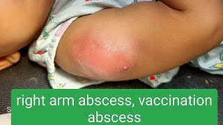 vaccination abscess [upl. by Annairba40]