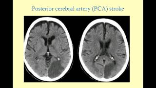 Stroke Syndromes older version with sound  CRASH Medical Review Series [upl. by Akli]