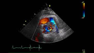 経胸壁心エコー図 感染性心内膜炎 IE 4 弁輪部膿瘍 大動脈弁短軸像カラードプラ Case 2 [upl. by Betthezel]