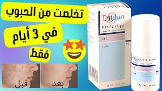 أسرع طريقة تعالجي بيها الحبوب ب epiduo gel عن تجربة  ضروري تشوفي الفيديو قبل الإستعمال ⚠️ [upl. by Rengia]