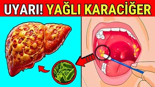 KARACİĞERİNİZİN YAĞLANDIĞINI GÖSTEREN 14 İŞARET  2 Bölüm [upl. by Bubb]