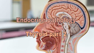 Endocrine pathology Thyroid gland part 2 [upl. by Perry]