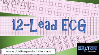 12 Lead ECG Quiz  MI Mimics and Sgarbossas Criteria [upl. by Ocker]