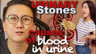 Blood in urine causes Urinary Tract Stone explained [upl. by Odlamur991]