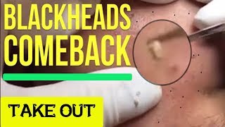 Blackheads Whiteheads Pimples And Cystic Acne Extraction Facial Treatment 0032017 [upl. by Eirrehc]