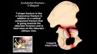 Acetabular Fracture T Shaped Fracture  Everything You Need To Know  Dr Nabil Ebraheim [upl. by Elyssa876]