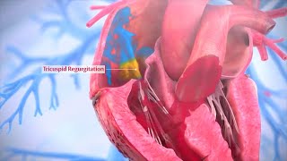 Tricuspid Valve Repair  Triluminate Clinical Trial [upl. by Krystyna]