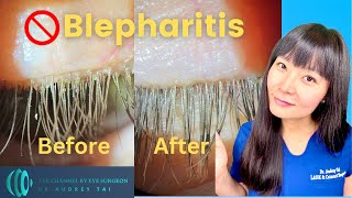 Best Blepharitis Treatments at Home  Simple amp Effective  Step by Step Guide Eye Surgeon Explains [upl. by Deppy177]