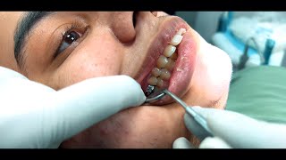 Mastering Orthodontics Treatments for Proclination Class II Malocclusion and Forward Placed Teeth [upl. by Eide]