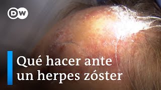 Primero varicela luego herpes zóster [upl. by Josh]