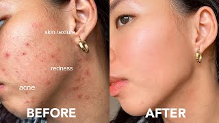 EASY WAY TO GET RID OF ACNE tiny bumps redness texture acne scars [upl. by Crescentia]