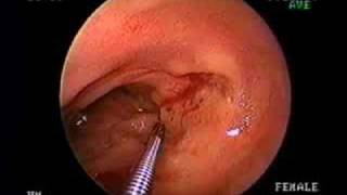 ENTERORRAGIA TIFICA Video del servicio de apoyo de gastroent [upl. by Hanfurd247]