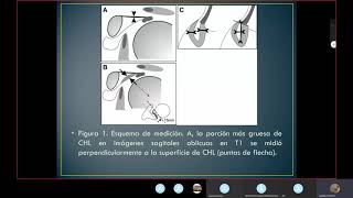 hombro congelado [upl. by Hawken]