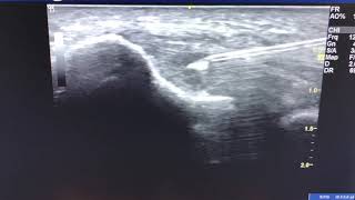 Tennis Elbow aka Lateral Epicondylitis 6 WEEKS FOLLOW UP after Ultrasound guided PRP Injection [upl. by Nylehtak993]