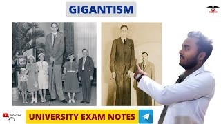 Gigantism  Cause  Signs amp Symptoms  Endocrine Physiology [upl. by Tansy]