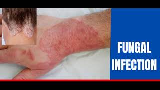 Fungal infectionskin Dr how to treat fungal infection [upl. by Marlo948]