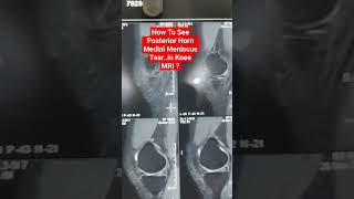 How To See Posterior Horn Medial Meniscus Tearin Knee MRI  drsaichandra kneemri [upl. by Animor]