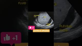 Ascites And Pleural Effusion abdomen usg ascites pleuraleffusion [upl. by Cynde894]