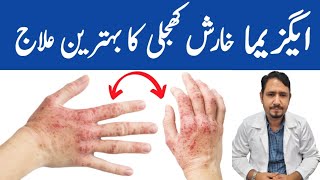 Magical Remedy For Eczema  Irfan Azeem [upl. by Taddeo]