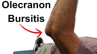 Olecranon Bursitis [upl. by Towbin]