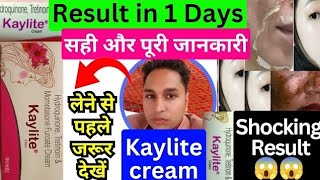 kaylite cream  kaylite cream ke fayde  kaylite cream lagane se kya hota hai  kaylite cream review [upl. by Thayer]