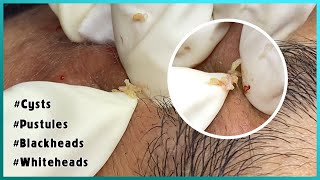 Big Cystic Acne Blackheads Extraction Blackheads amp Milia Whiteheads Removal Pimple Popping [upl. by Annovoj]