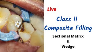 Live Class II Composite Dental Filling Molar amp Premolar with Sectional Matrix amp Wedge [upl. by Hecklau]