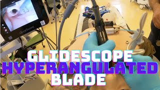 How to Intubate your patient with a GlideScope Hyperangulated Blade [upl. by Leahcimnoj222]