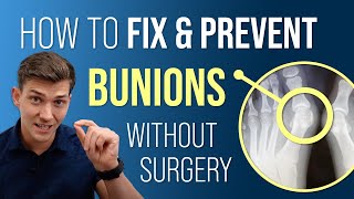 DO BUNION CORRECTORS WORK Doctor explains [upl. by Winfrid773]