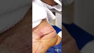 CoolSculpting Elite Live Patient Treatment [upl. by Lucic201]