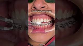 El mejor diseño de sonrisa  Adiós Brackets  Odontología Láser Shorts [upl. by Stanfill]