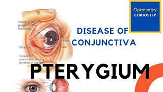 Pterygium👁️disease of conjunctiva In HindiAk khurana ophthalmology📚by Miss optom Ritika yadav📚 [upl. by Anafetse]