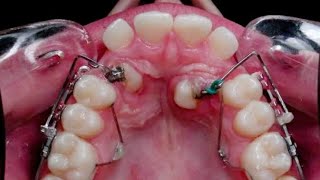 orthodontic treatment for palatally impacted canine WAIT 🔥 [upl. by Waldner]