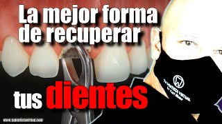 LOS IMPLANTES DENTALES CAMBIARON ¿LO SABÍAS [upl. by Ahtikal]