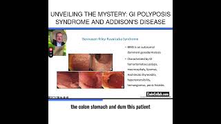 Unveiling the Mystery GI Polyposis Syndrome and Addisons Disease [upl. by Alard]