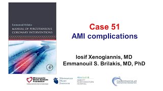 Case 51 PCI Manual  MI complications [upl. by Alverson831]