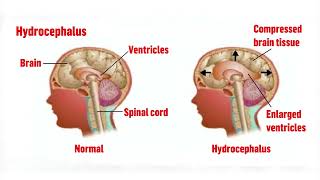 MENINGITIS BRAIN FEVER [upl. by Reffineg]