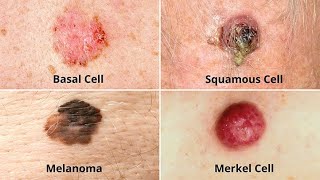 Understanding Skin Cancer Types Causes Symptoms Treatment and Prevention [upl. by Oirevlis]