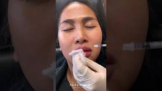 Natural Lip Filler Results with Restylane Kysse [upl. by Anoerb]