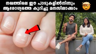 നഖത്തിലെ ഈ പാടുകളിൽനിന്നും ആരോഗ്യത്തെ കുറിച്ചു മനസിലാക്കാം What Your Nails Reveal About Your Health [upl. by Koziarz]