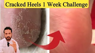 Cracked Heels 1 Week Solution  Quick Cracked Heel Treatment [upl. by Boatwright761]