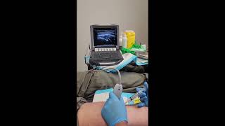 Pes Anserine bursitis injection under ultrasoundguidance [upl. by Sophia]