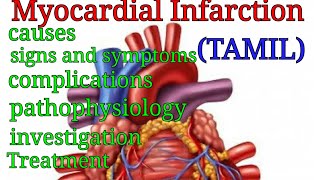 Myocardial infarction in Tamil class medics [upl. by Illac]