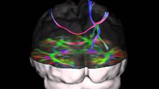 Fiber tractography [upl. by Acinimod]