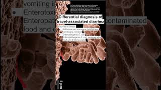 Differential diagnosis of travelassociated diarrhea [upl. by Mauchi]