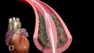 Coronary Angioloplasty [upl. by Wolpert535]