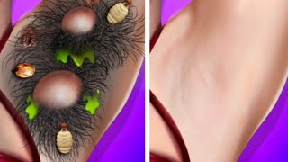 ASMR  ワックスがけの前に脇の下の虫を取り除く Removal armpit worms befor waxing  underarm skin care [upl. by Dutchman]